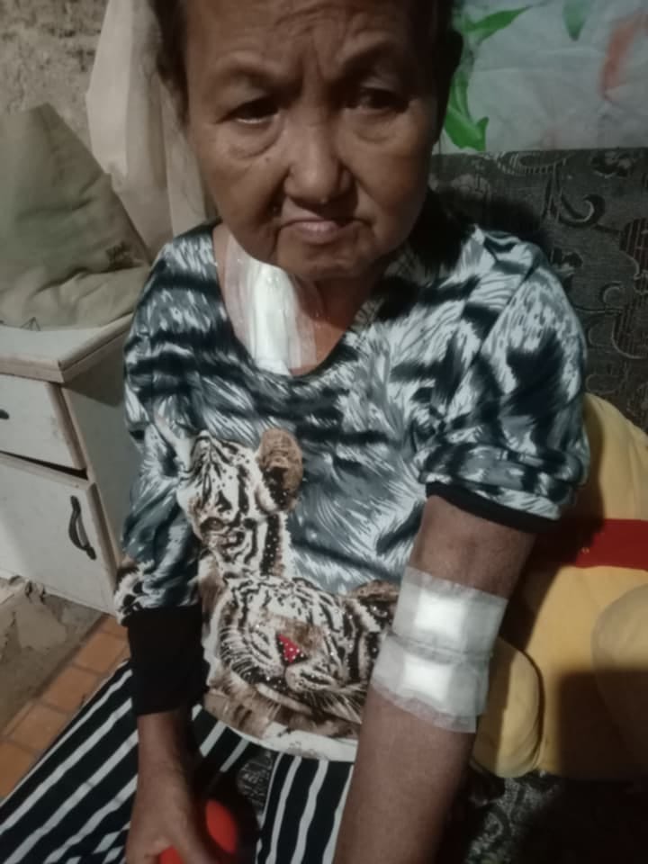 Fistula-Dialysis operation CKD Stage 5 Mother 69 years old
